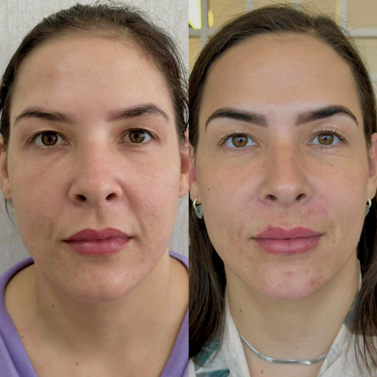 Resultado de Harmonização facial — antes e depois