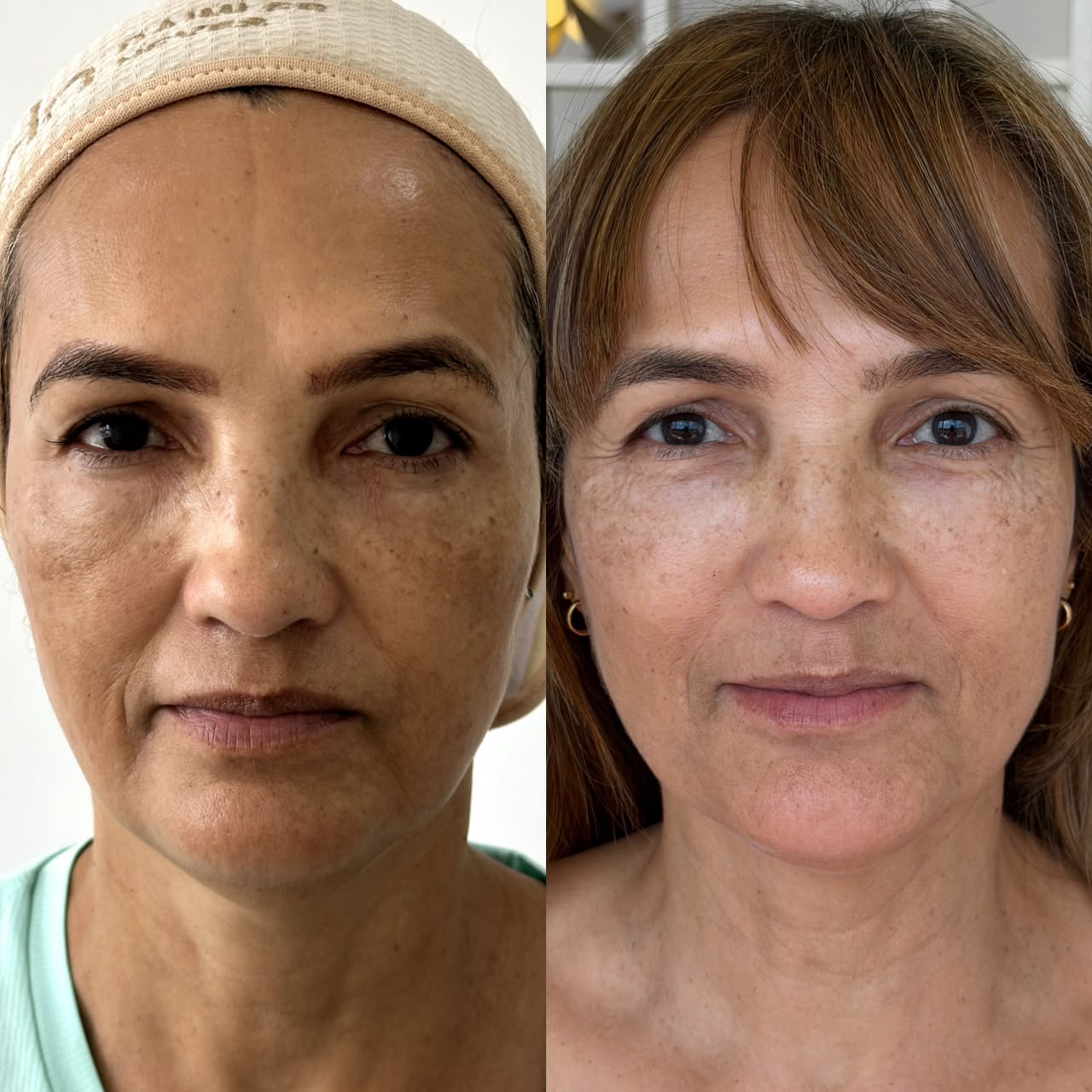 Resultado de Procedimentos de Rejuvenescimento — antes e depois
