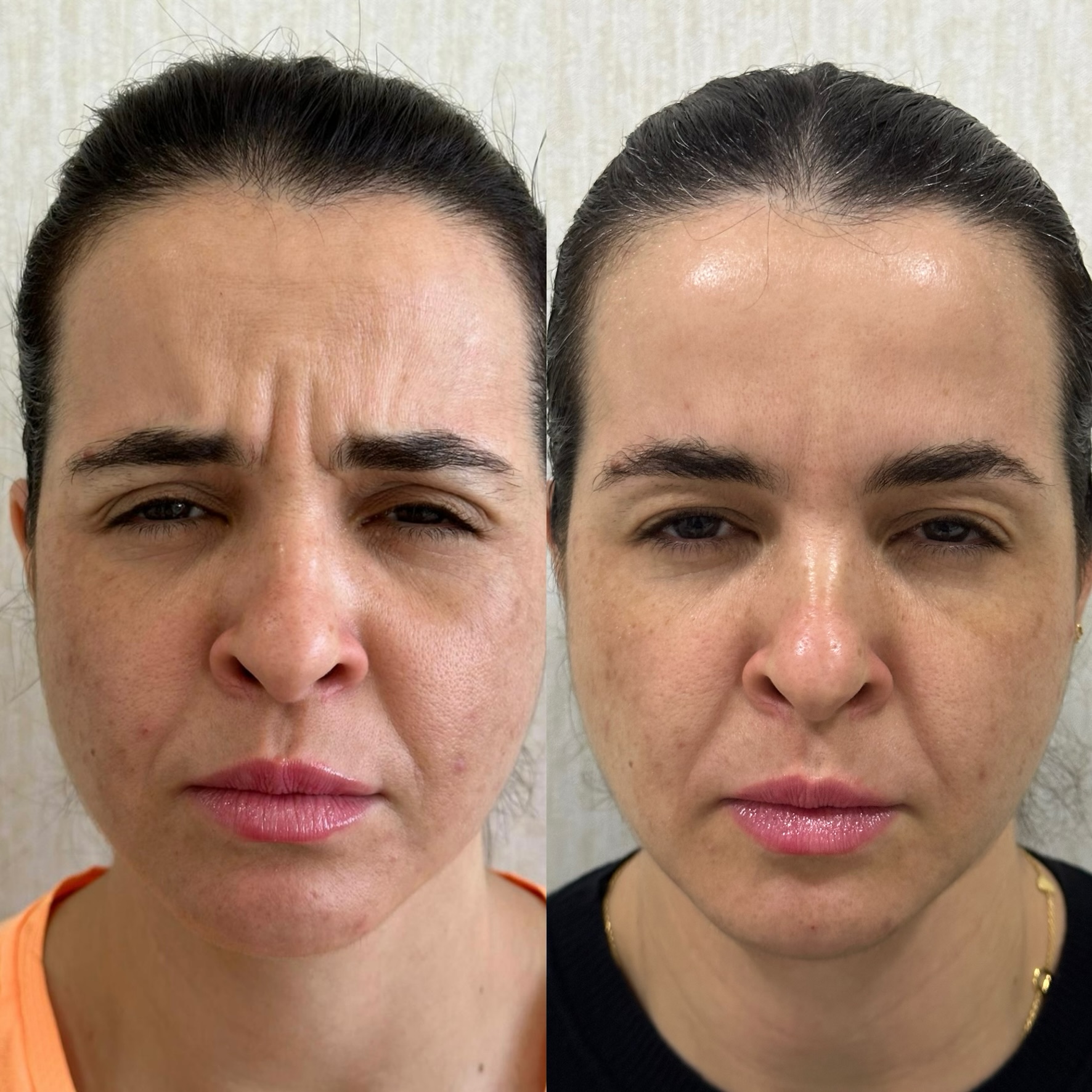 Botox