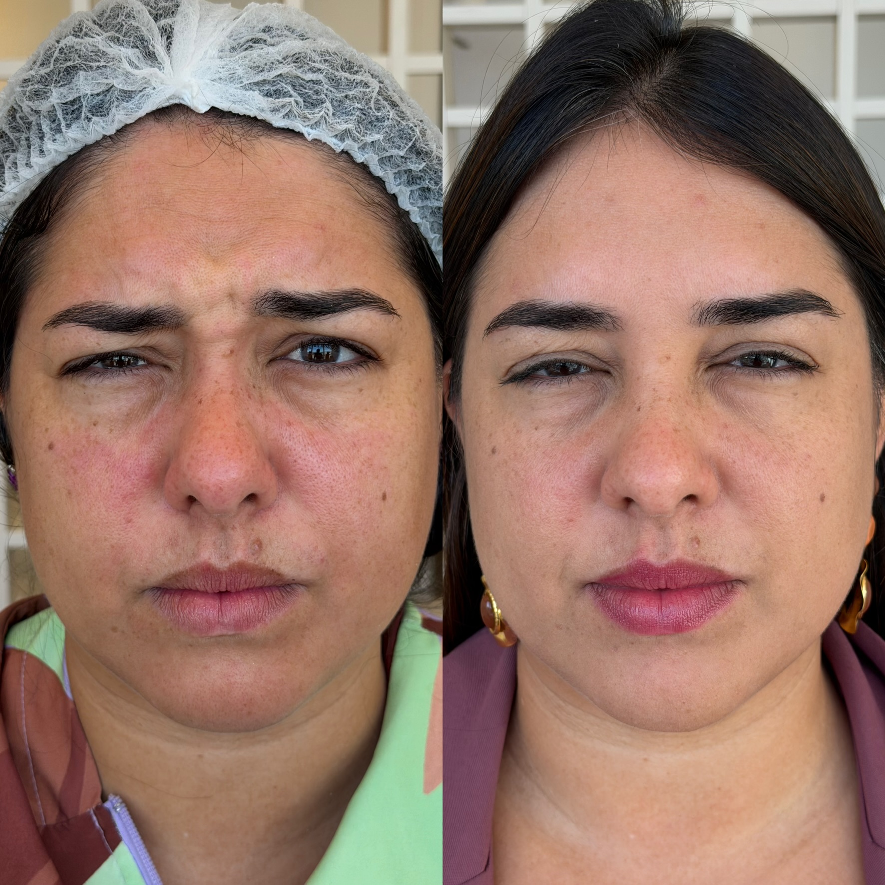 Resultado de Botox — antes e depois