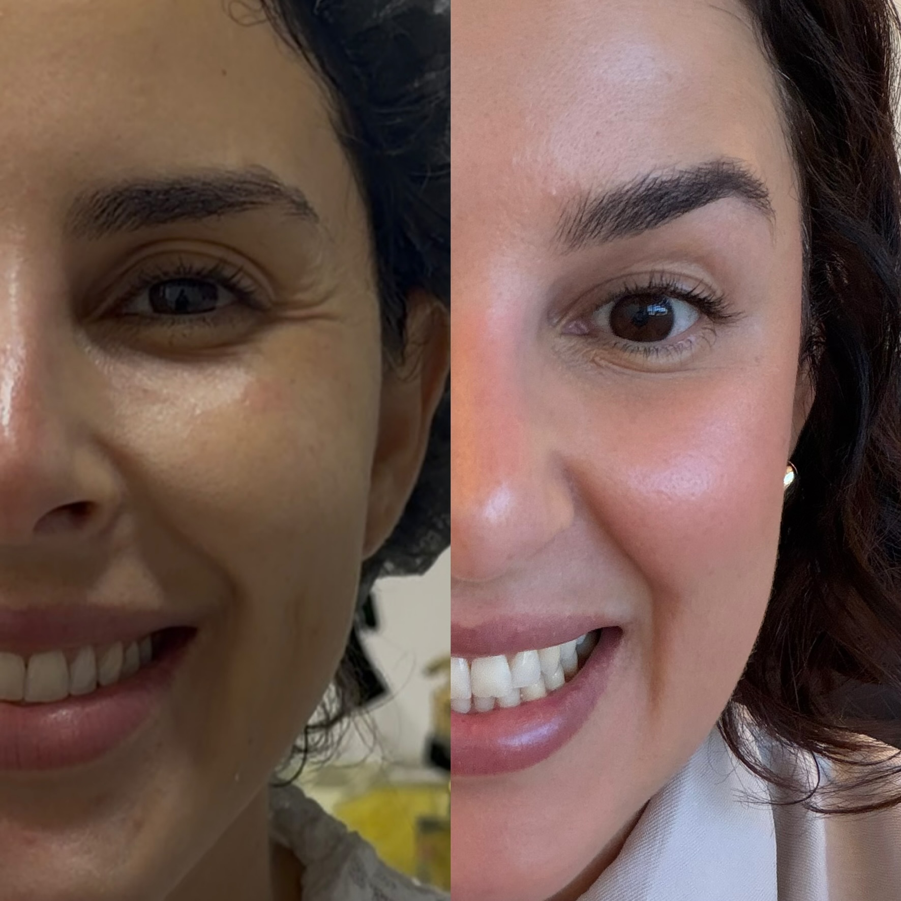 Resultado de Botox — antes e depois