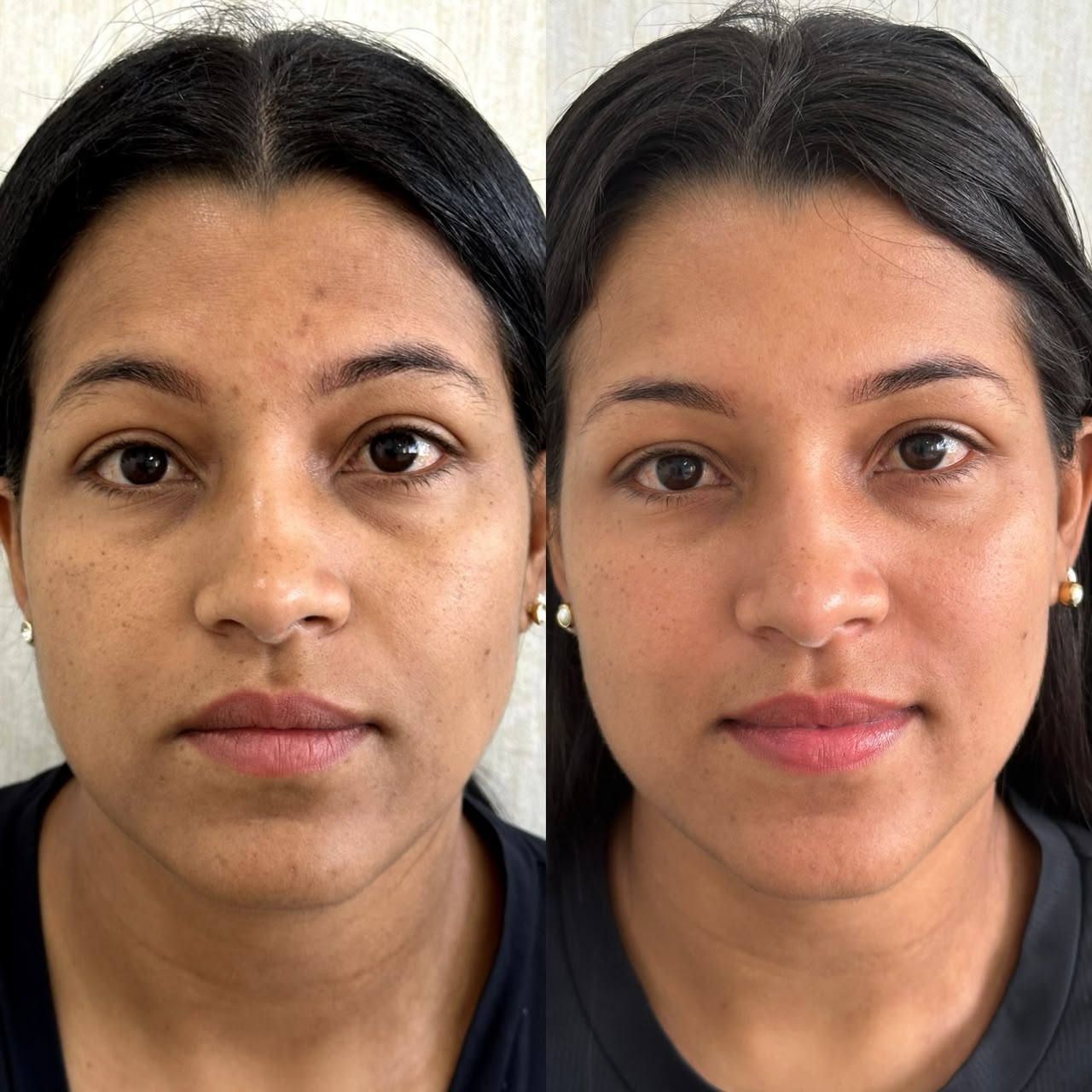 Resultado de Procedimentos de Rejuvenescimento — antes e depois