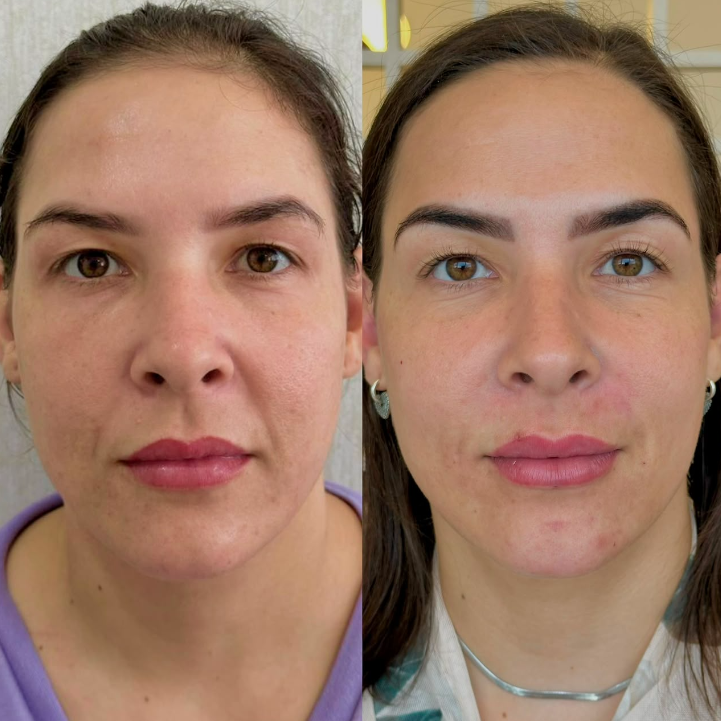 Resultado de Harmonização facial — antes e depois