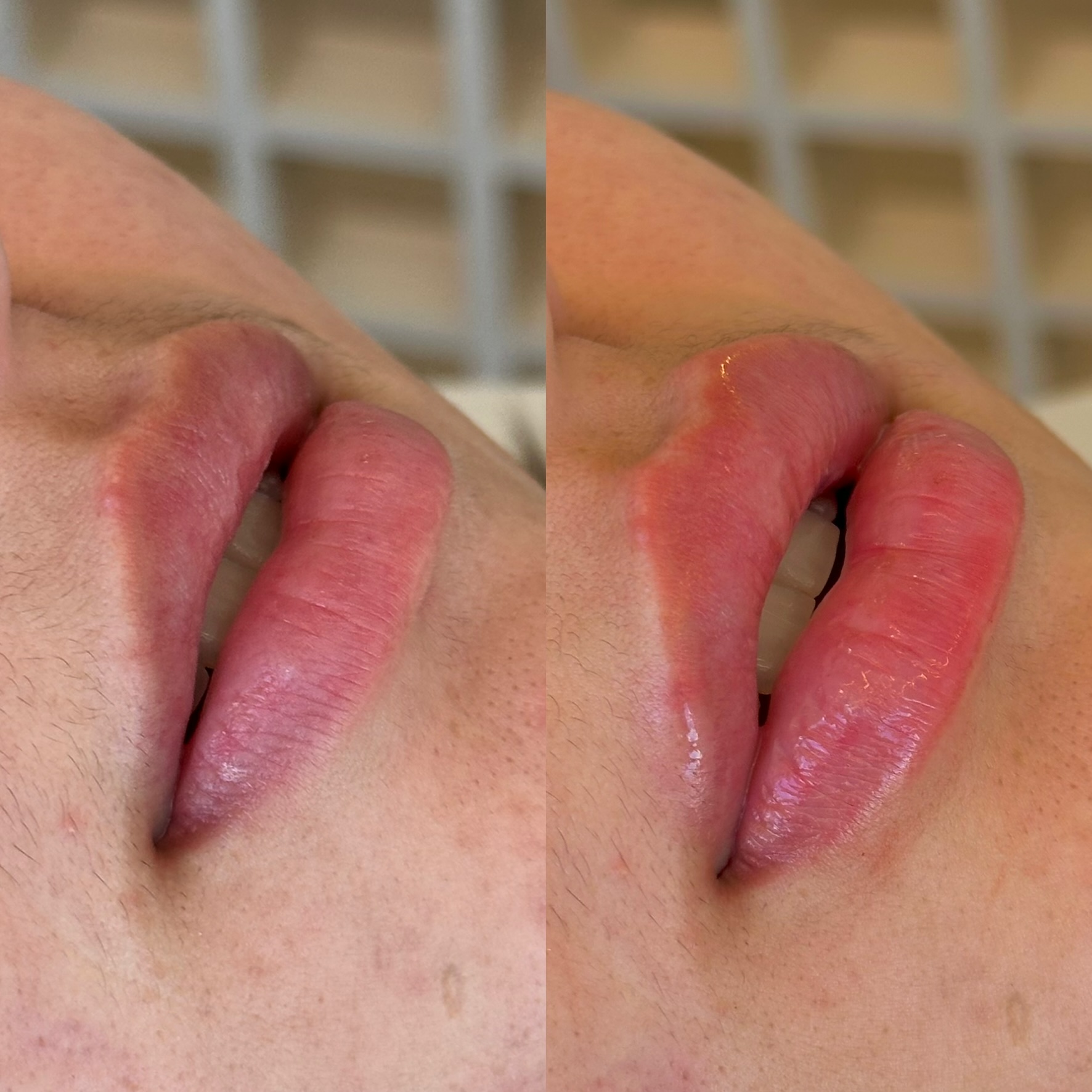 Resultado de Preenchimento labial — antes e depois