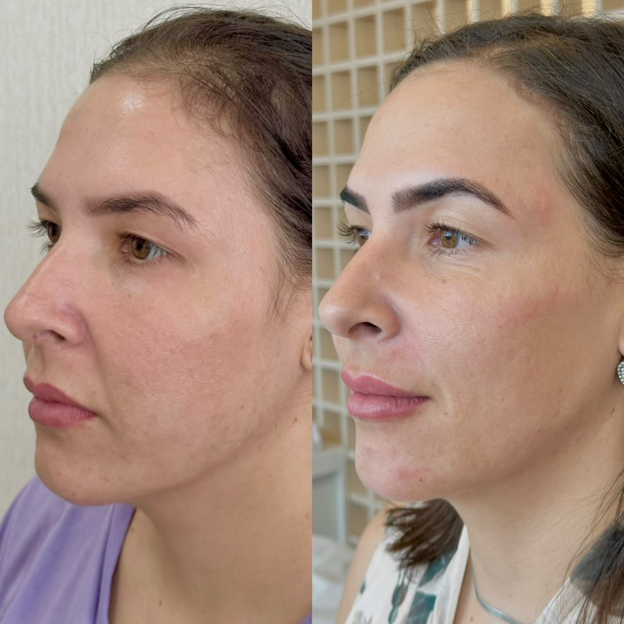 Resultado de Harmonização facial — antes e depois