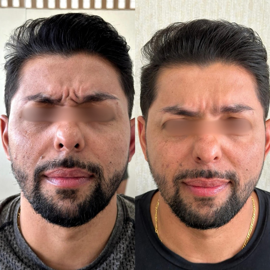 Resultado de Botox — antes e depois