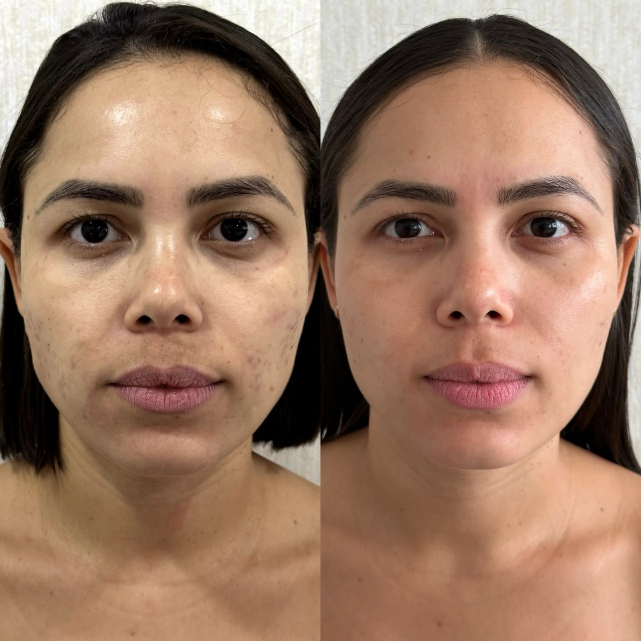 Resultado de Procedimentos de Rejuvenescimento — antes e depois